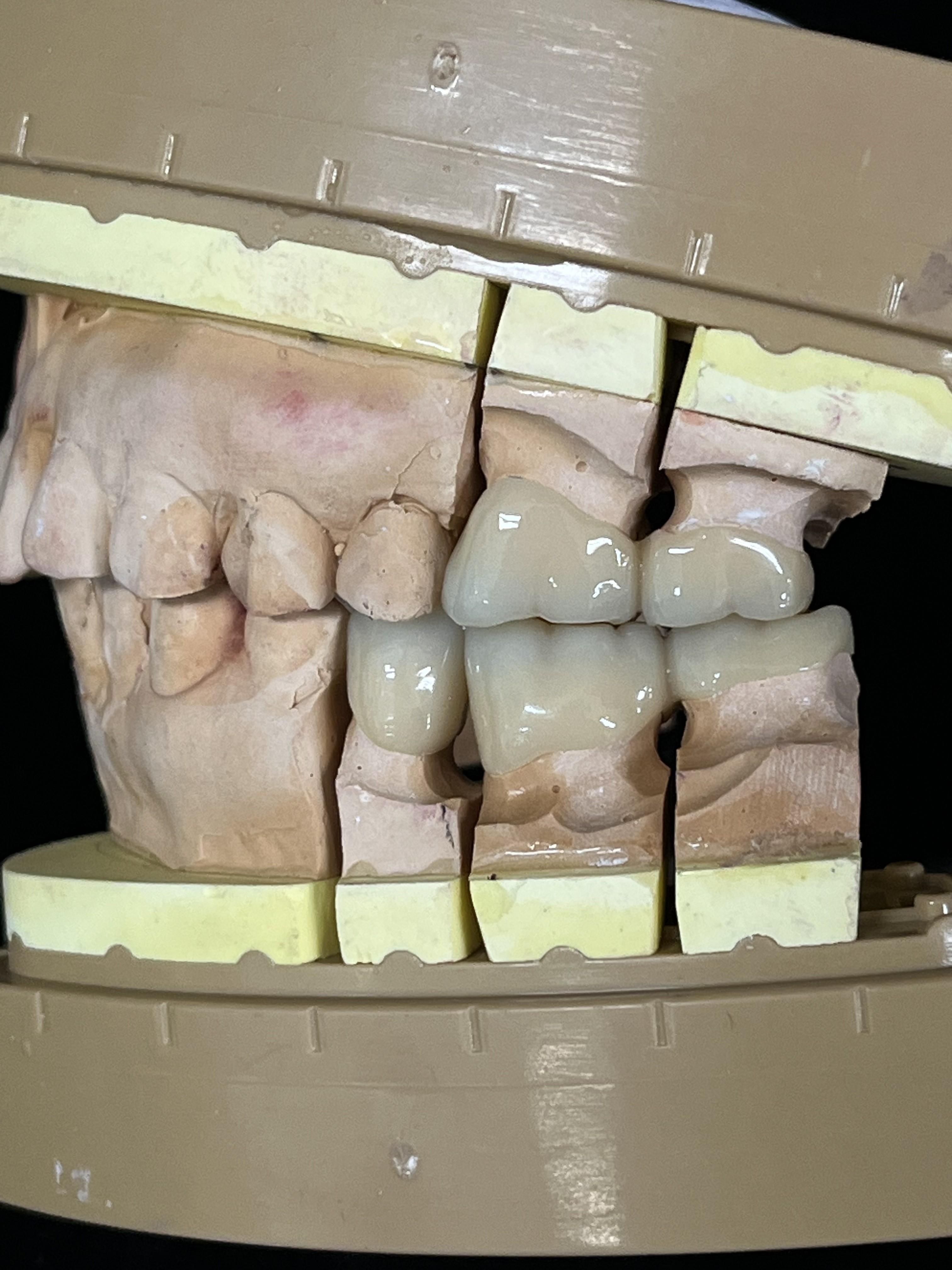 임플란트 크라운